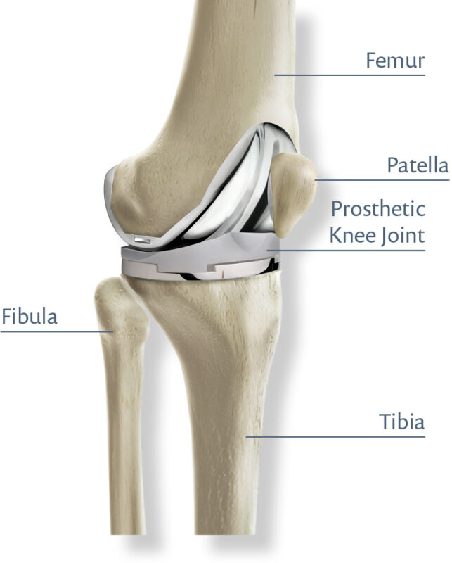 Knee replacement
