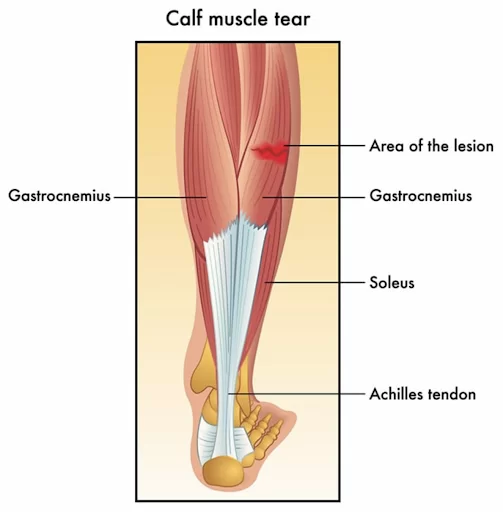 Calf-Strain-Diagram