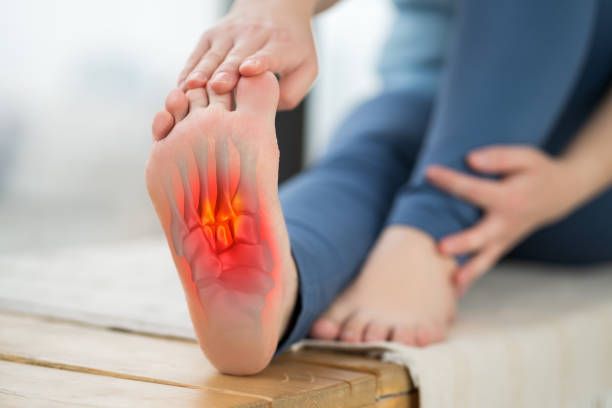 Plantar Fasciitis physio